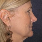Facelift Before & After Patient #716