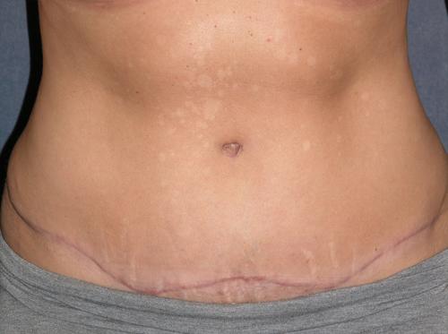 Tummy Tuck Before & After Patient #590