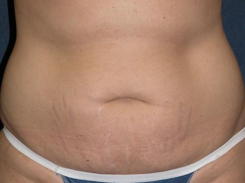 Tummy Tuck Before & After Patient #590