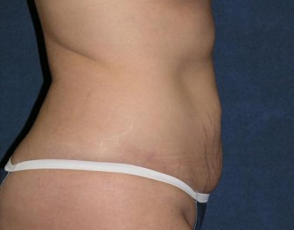 Tummy Tuck Before & After Patient #590