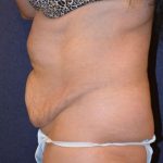 Tummy Tuck Before & After Patient #585