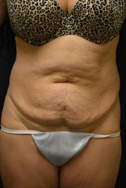 Tummy Tuck Before & After Patient #585
