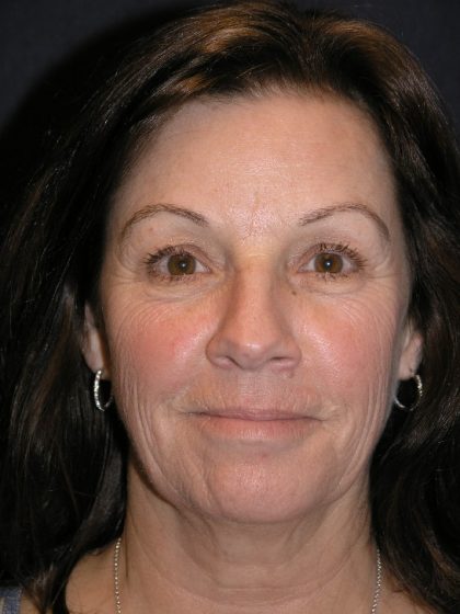 Blepharoplasty Before & After Patient #1374