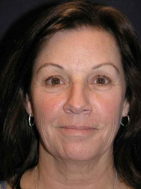 Facelift Before & After Patient #1374