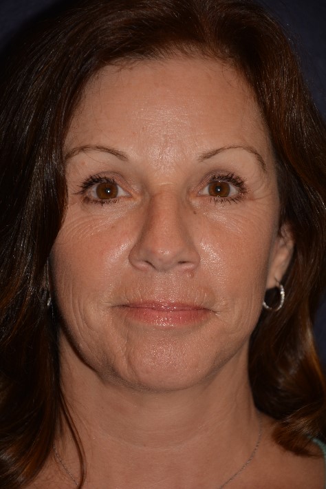 Facelift Before & After Patient #1374