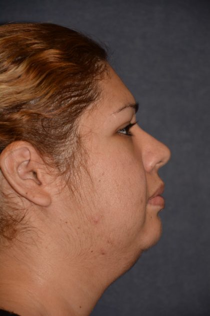 Neck Lift Before & After Patient #1379
