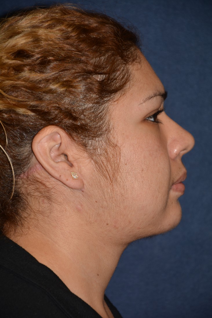 Neck Lift Before & After Patient #1379