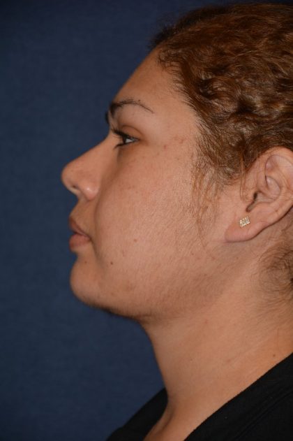 Neck Lift Before & After Patient #1379