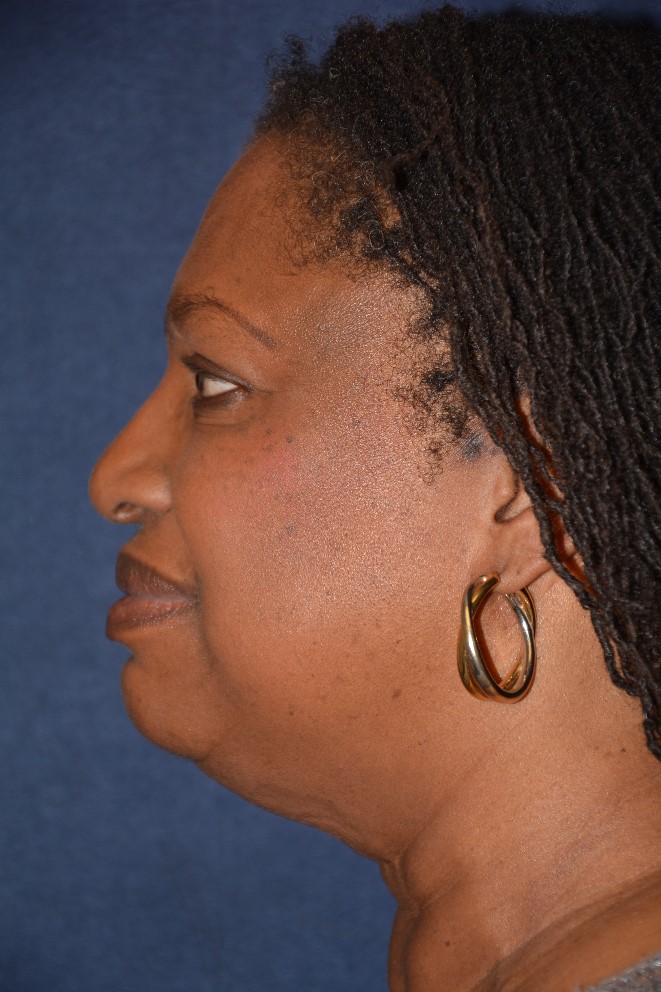 Neck Lift Before & After Patient #1390