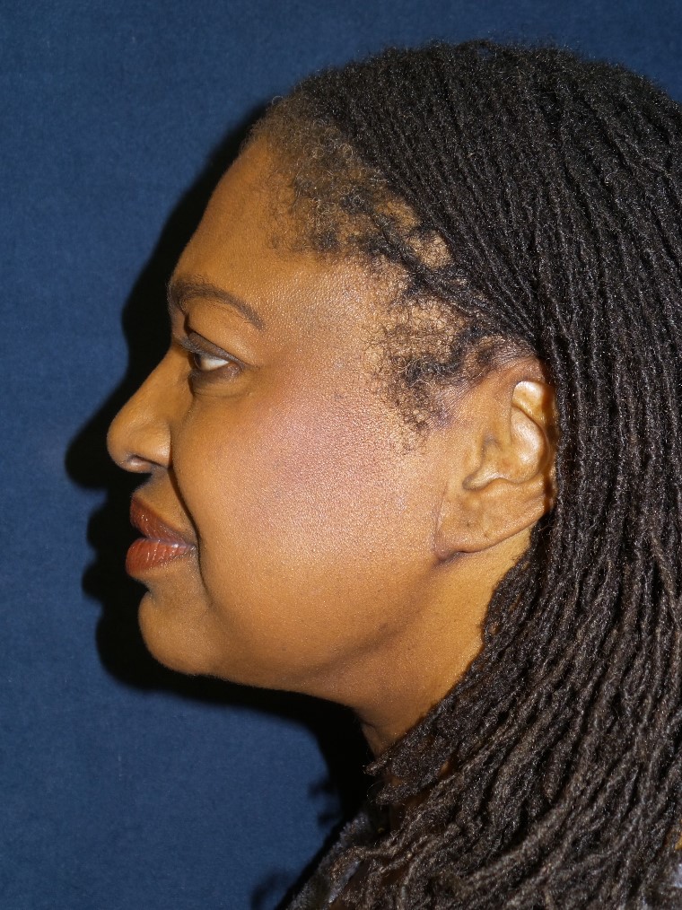 Neck Lift Before & After Patient #1390