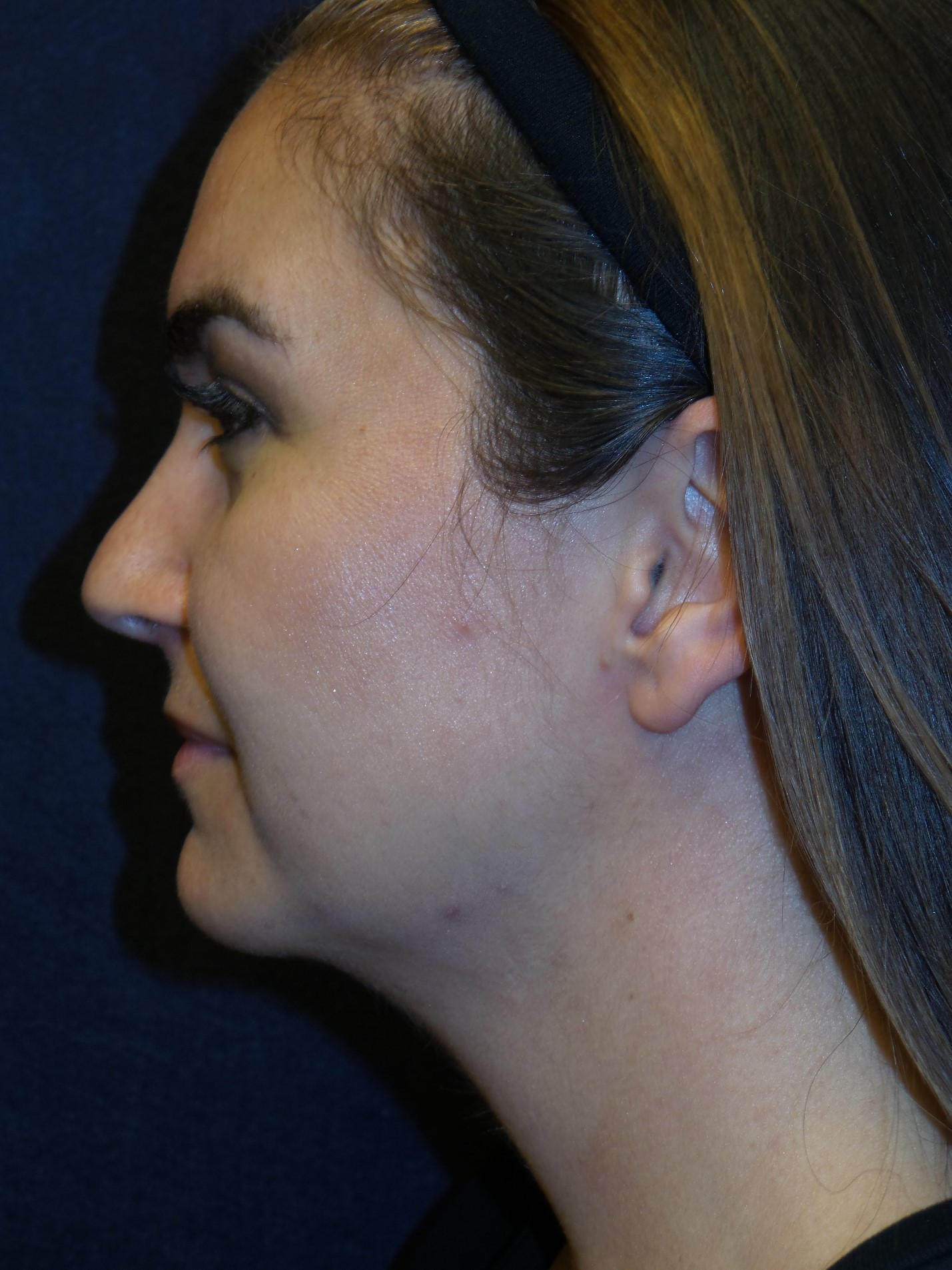 Neck Lift Before & After Patient #1391