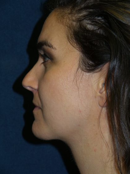 Neck Lift Before & After Patient #1391