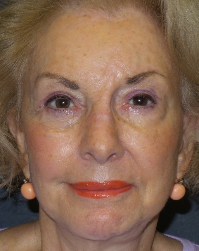 Facelift Before & After Patient #1350