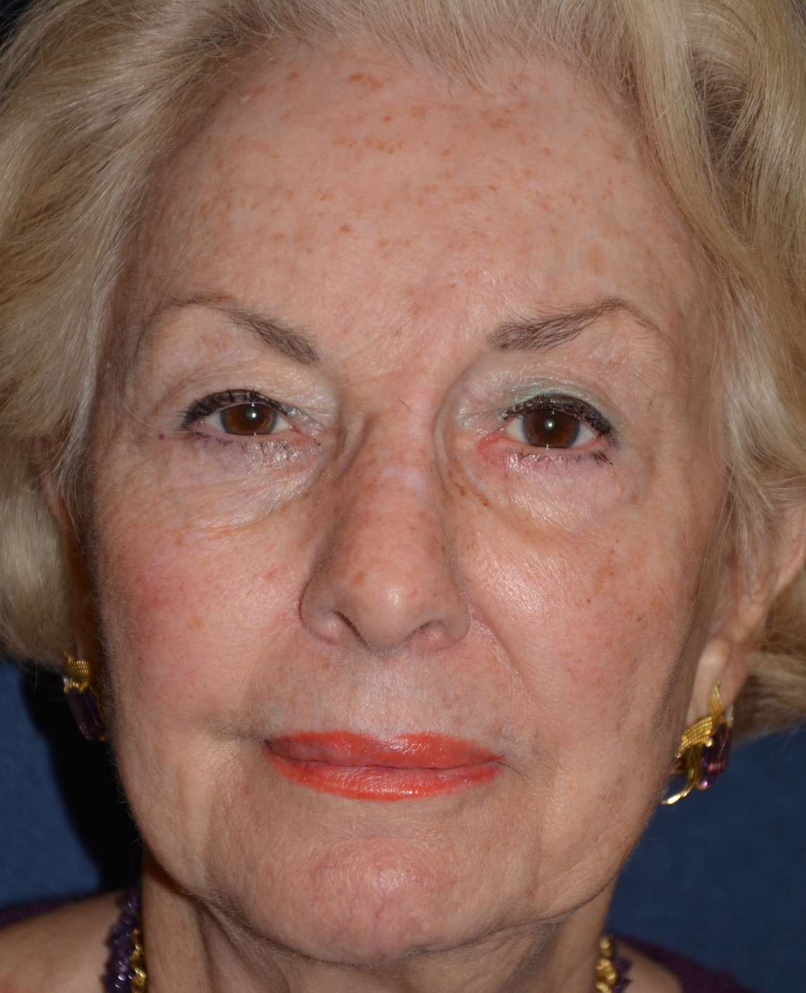 Facelift Before & After Patient #1350
