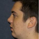 Chin Augmentation Before & After Patient #1345