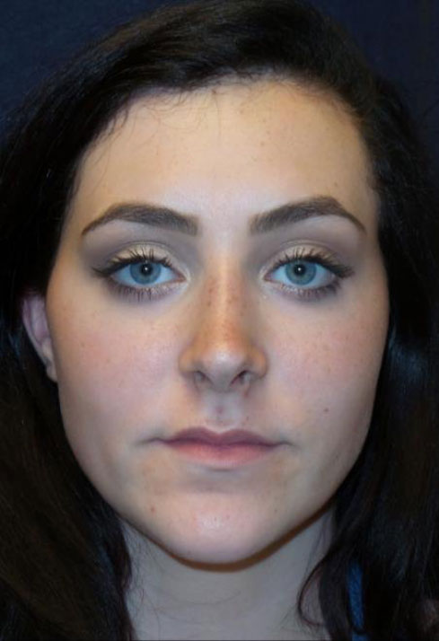 Rhinoplasty Before & After Patient #1361