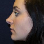 Rhinoplasty Before & After Patient #1361