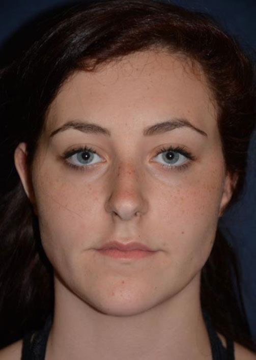 Rhinoplasty Before & After Patient #1361