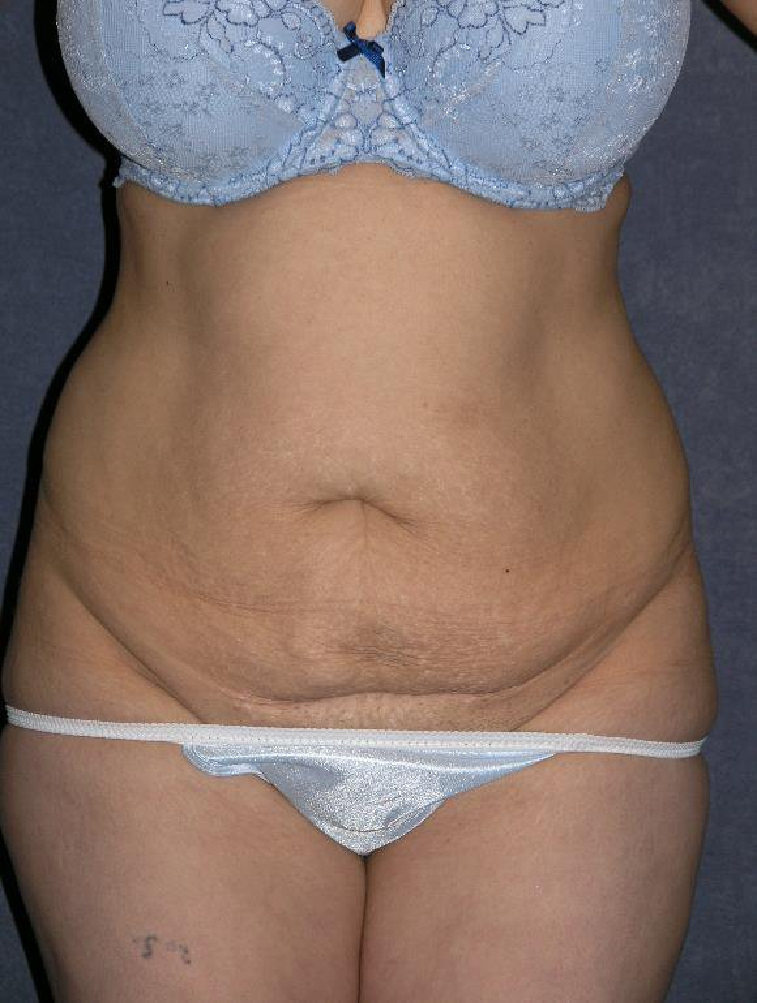 Tummy Tuck Before & After Patient #1464