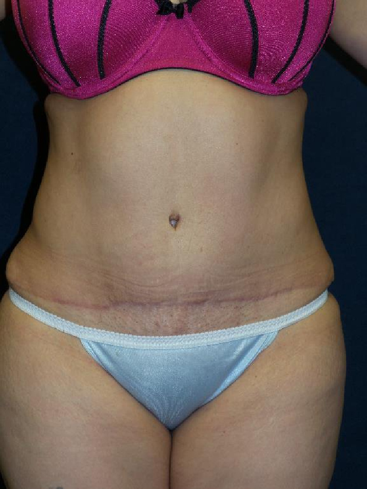Tummy Tuck Before & After Patient #1464