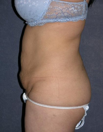 Tummy Tuck Before & After Patient #1464