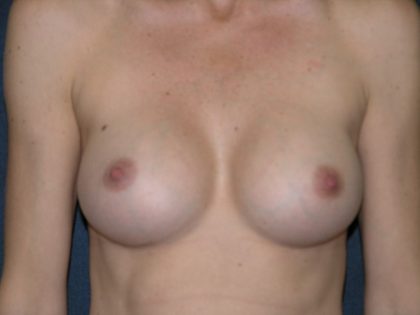 Breast Augmentation Before & After Patient #1432
