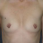 Breast Augmentation Before & After Patient #1432