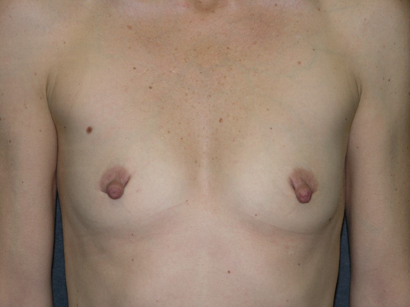 Breast Augmentation Before & After Patient #1432