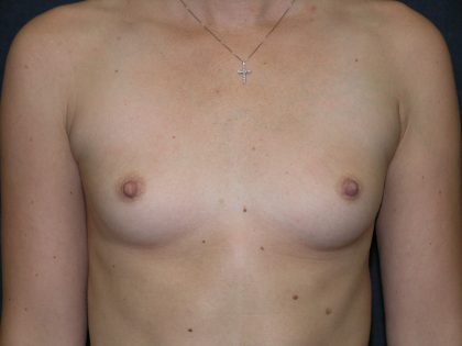 Breast Augmentation Before & After Patient #1437