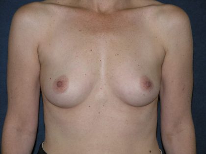 Breast Augmentation Before & After Patient #1419