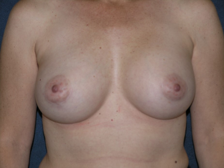 Breast Augmentation Before & After Patient #1419