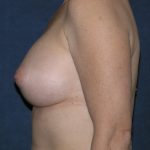 Breast Augmentation Before & After Patient #1419