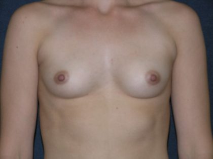 Breast Augmentation Before & After Patient #1452