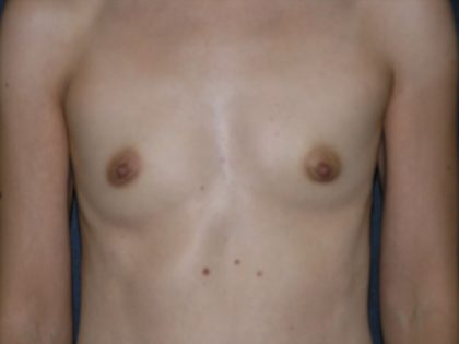 Breast Augmentation Before & After Patient #1442