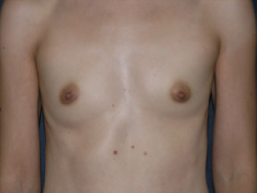Breast Augmentation Before & After Patient #1442