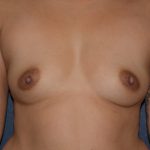 Breast Augmentation Before & After Patient #1447