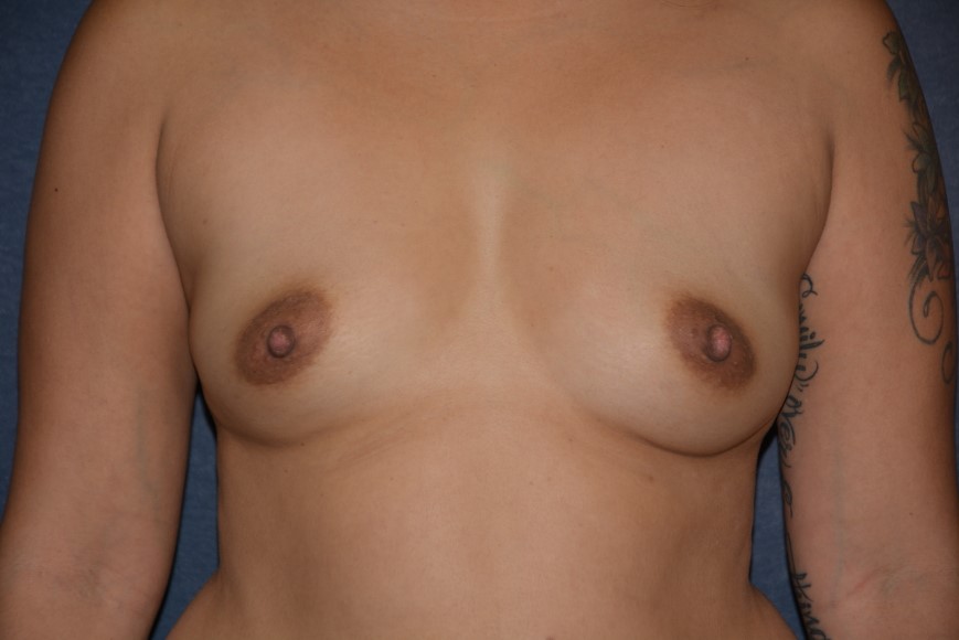 Breast Augmentation Before & After Patient #1447