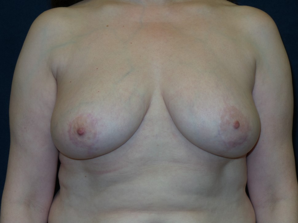 Breast Reduction Before & After Patient #1414