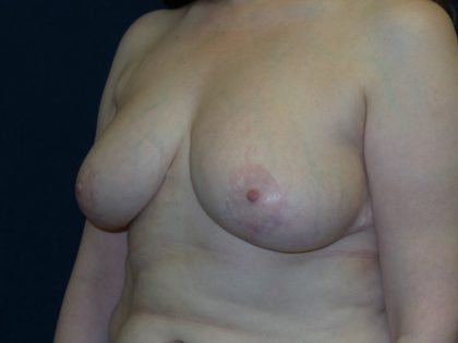 Breast Reduction Before & After Patient #1414
