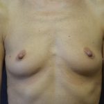 Breast Augmentation Before & After Patient #1409