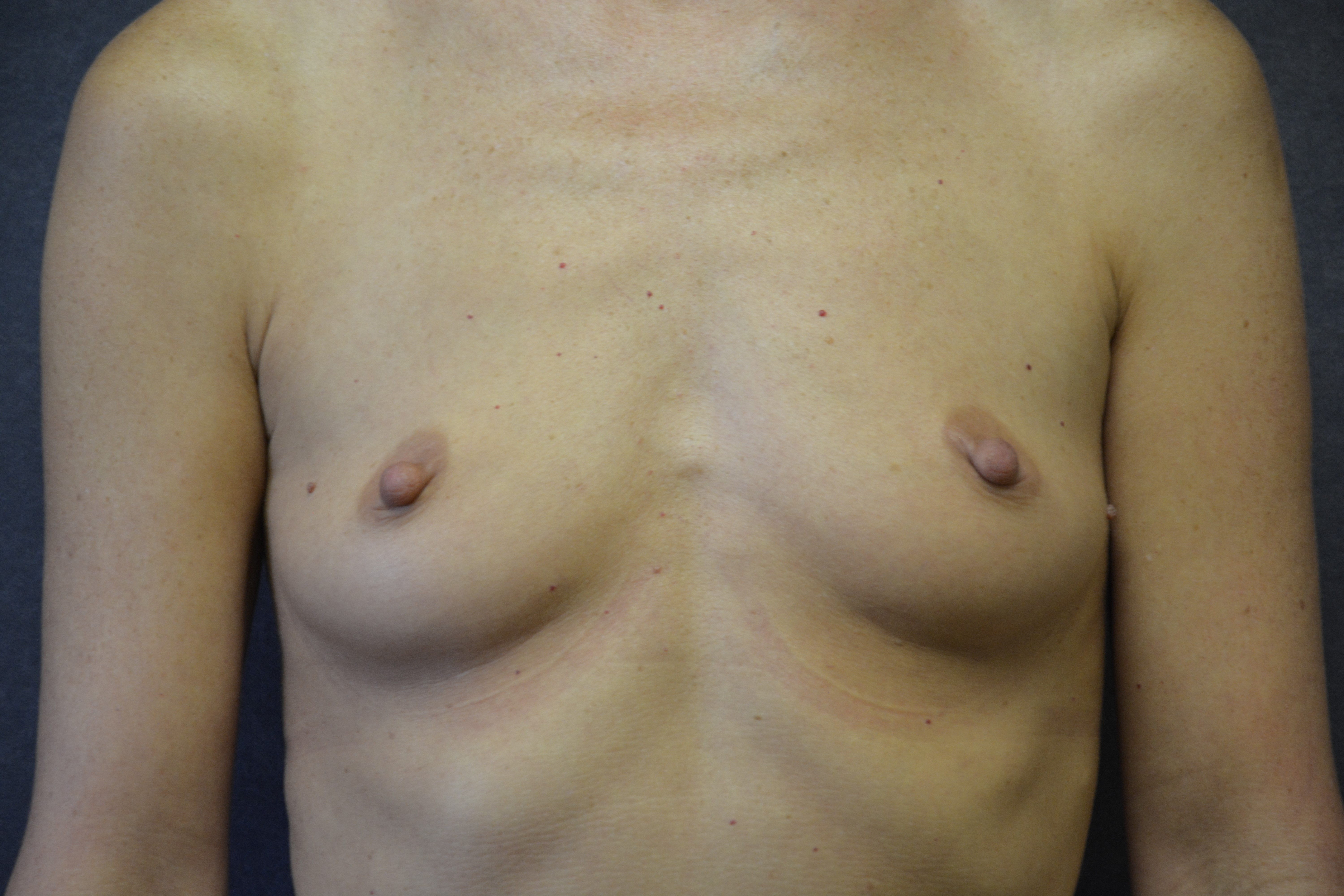 Breast Augmentation Before & After Patient #1409