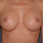 Breast Augmentation Before & After Patient #1409