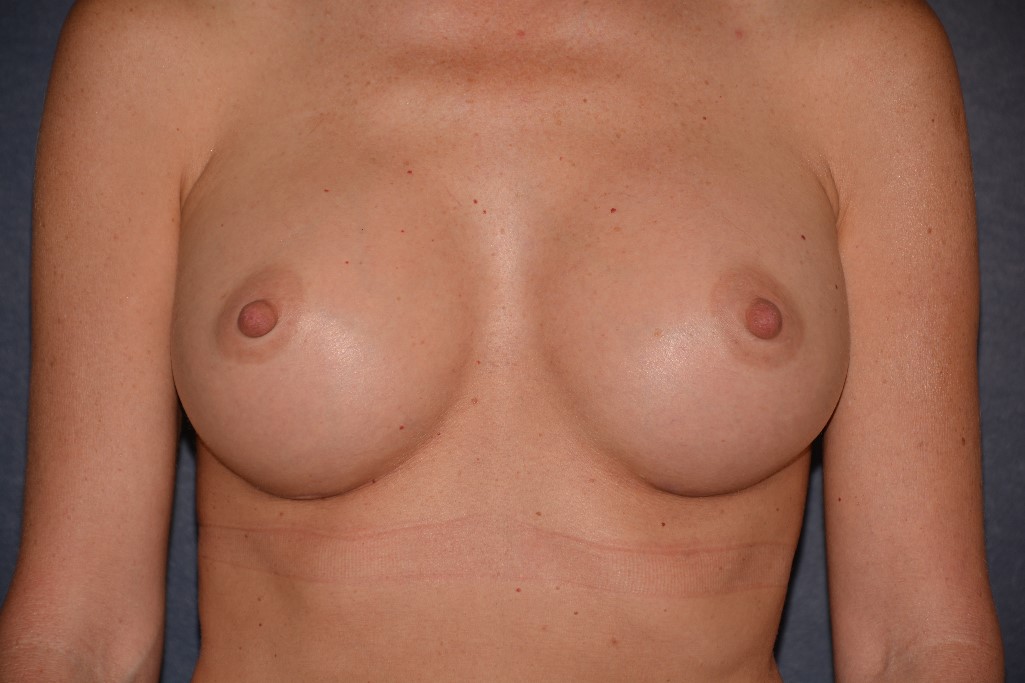 Breast Augmentation Before & After Patient #1409