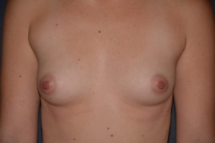 Breast Augmentation Before & After Patient #1424