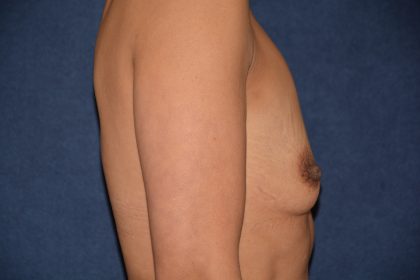 Breast Augmentation Before & After Patient #1474
