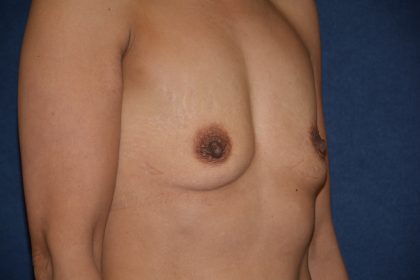 Breast Augmentation Before & After Patient #1474