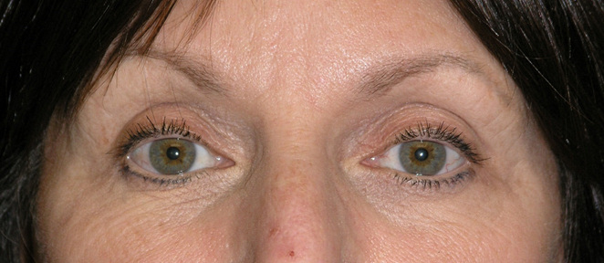 Active FX Laser Before & After Patient #1429