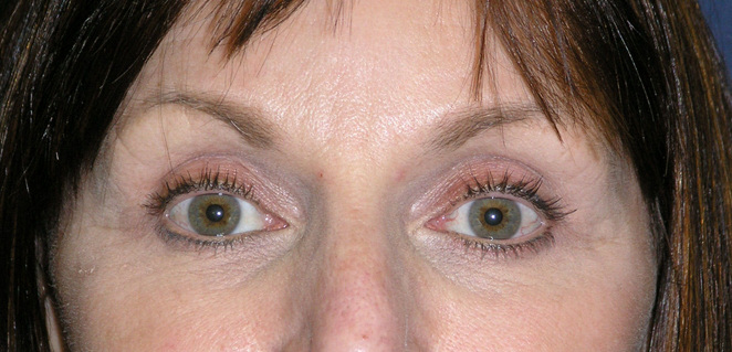 Active FX Laser Before & After Patient #1429