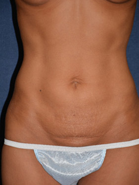 Tummy Tuck Before & After Patient #1457