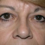 Blepharoplasty Before & After Patient #1499